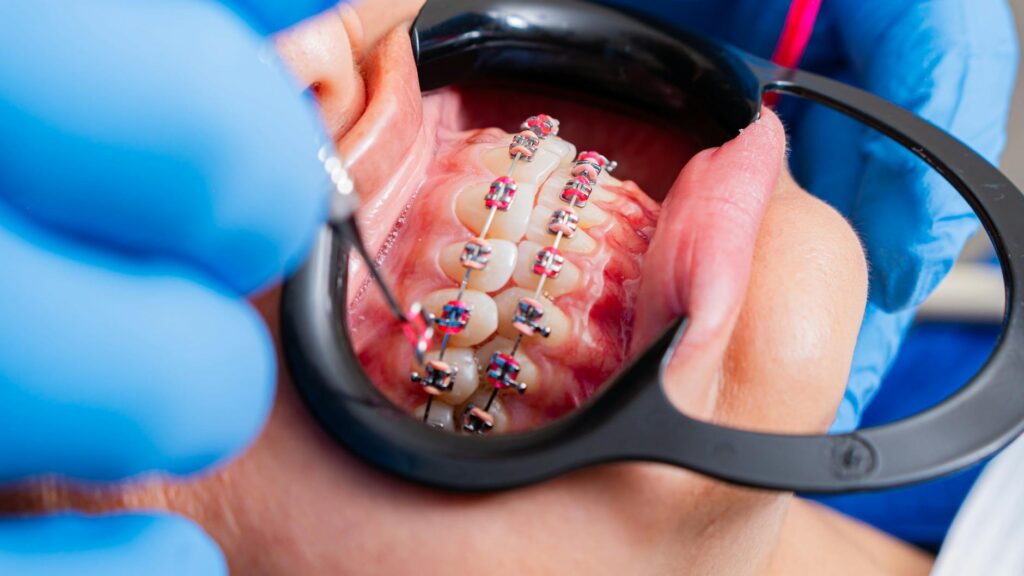 Como Passar Fio Dental com Aparelho: Guia Completo